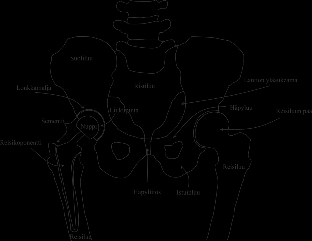 3.2 Lonkan anatomian vaikutus tekonivelleikkaukseen Potilaan lonkan anatomiasta ja sukupuolesta riippuen reisiluun ydinontelon laajuus ja muoto, lantionpohjan paksuus sekä reisiluun kaulan kulma ja