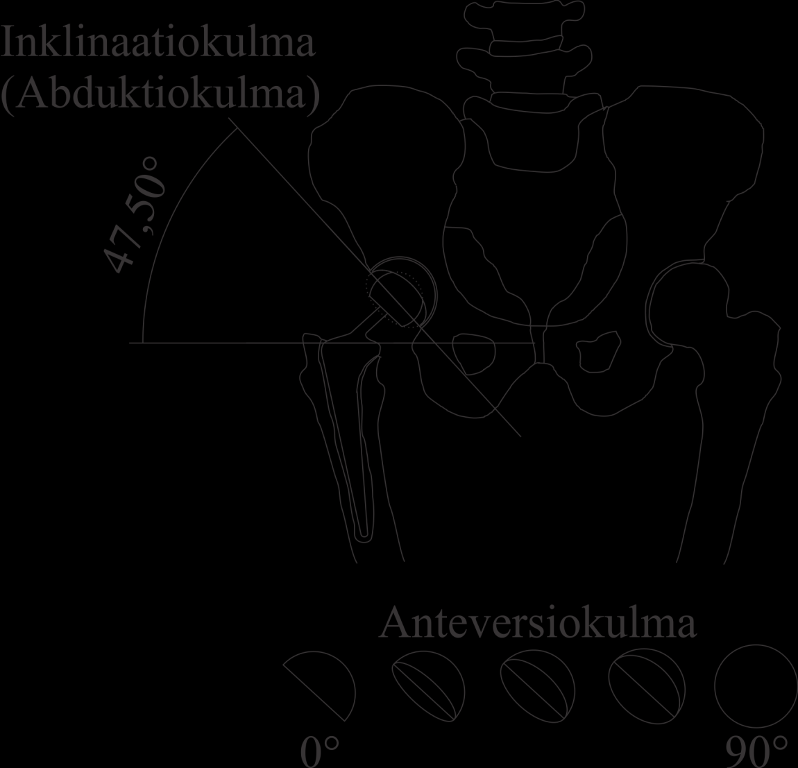 41 Kuva 25: Lonkkaimplantin acetabulum-komponentin inklinaatio- ja anteversiokulmat. Inklinaatiokulman sijasta voidaan käyttää termiä abduktiokulma.