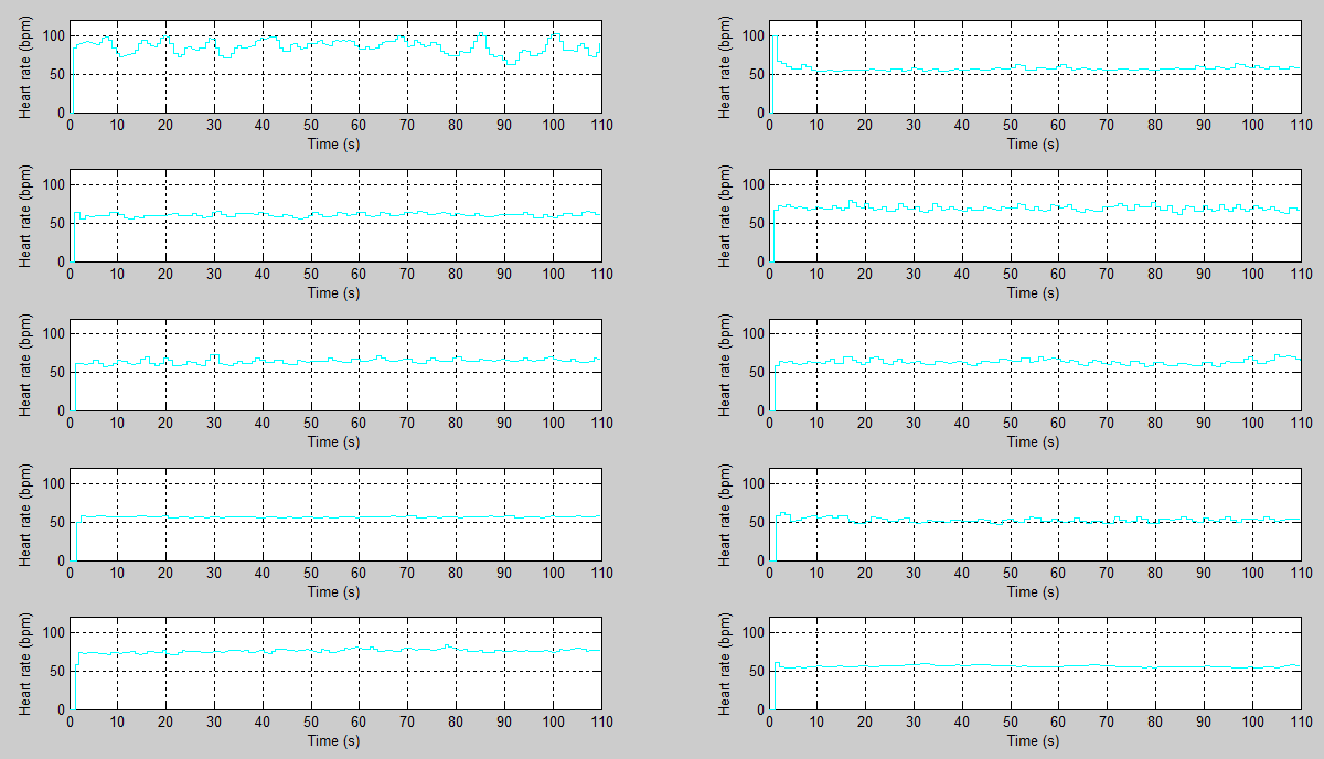 Kuva 26. EKG:n vasemmalta oikealle.