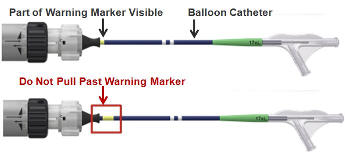 Balloon Lock mechanism on the handle of the Edwards Commander System may not fully engage to the balloon catheter during the Fine Adjustment part of the Valve Alignment procedure.