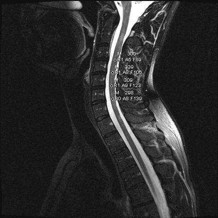 21 2.3 Tutkimusmetodit Potilaiden MRI-kuvista analysoitiin diffuusiopainotteiset kaularangan alueen kuvat väliltä C3 C7 kustakin nikamavälistä (kuva 4).