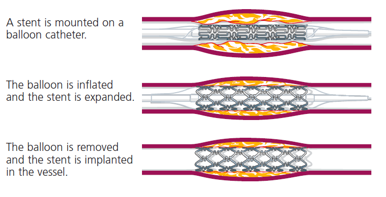 Esimerkkejä tuotteista - Sepelvaltimostentti Biostabiili: Cypher TM Sirolimus-eluting Coronary Stent Ruostumatonta terästä Lääkeaine