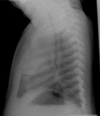 Erotusdiagnostisia haasteita 1(2) Thymuksen muoto