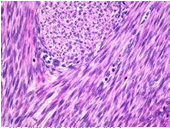 Med12 in rare myoma subtypes Hypercellular 7/59 (11,9%) Atypical 3/17 (17,6%) Mitotically active 8/22