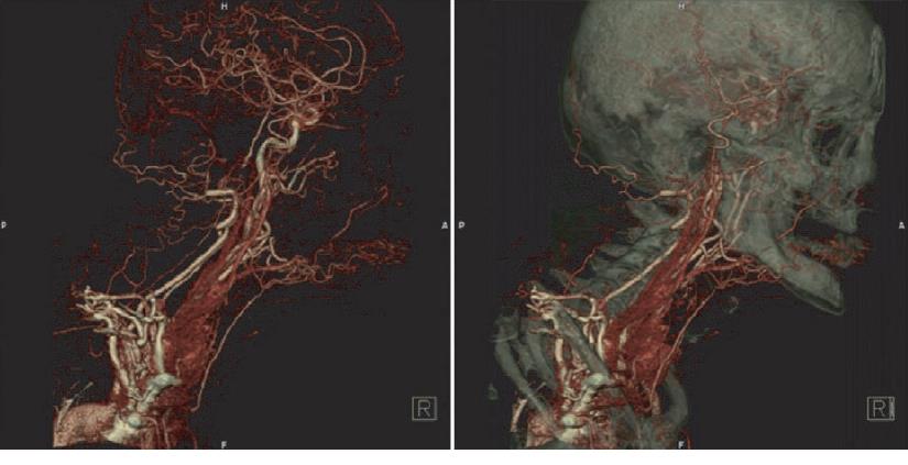 24 Kuva 18. Vokseleiden harmaasävyjen siirtofunktiot väreille ja läpinäkyvyydelle [3, s. 199] Kuva 19. Volume rendering -tekniikalla luotu CT-angiografiakuva.