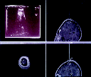 A B Kuva 1. A) Neuronavigaattorin osoitinvarsi, jonka avulla neurokirurgi näkee monitorista preoperatiivisten kuvien pohjalta lasketun leikkeen missä tahansa suunnassa.