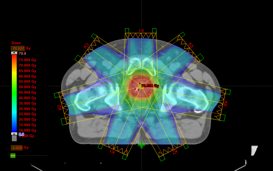 Kuva 6. IMRT-tekniikan kenttäjärjestely eturauhassyövän sädehoidossa. Kuva 7. 3D-CRT-tekniikan kenttäjärjestely eturauhassyövän sädehoidossa.