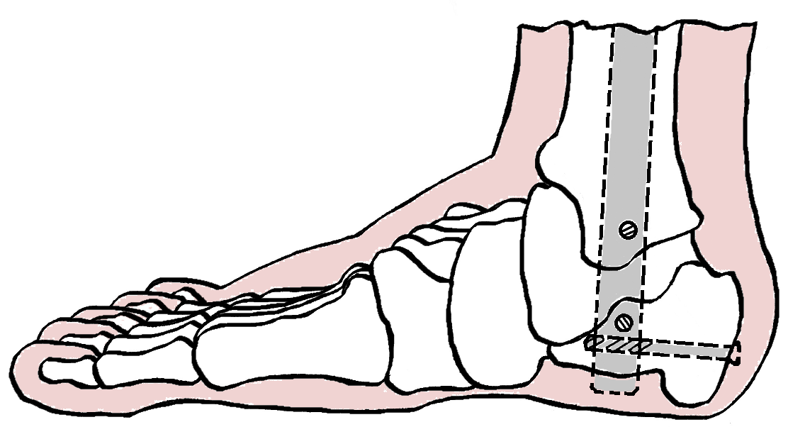 Kuva 1. Nykyaikainen nilkkaydinnaula. Ydinnaula viedän sisään kantapään ihoviillosta. Naula läpäisee calcaneuksen ja taluksen asettuen tibian ydinonteloon.