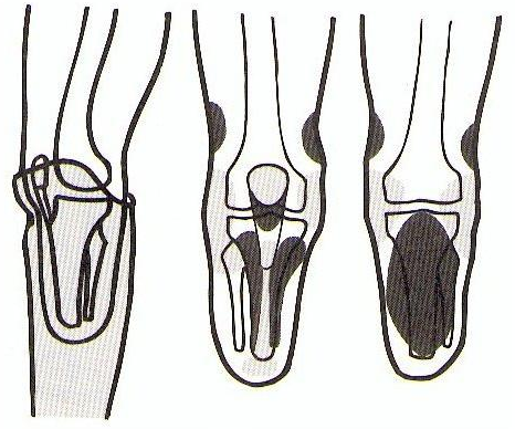 19 KUVA 7. Käytetyimmän sääriproteesin, PTB-proteesin (Patellar-Tendon-Bearing), periaate ja parhaiten suoraa kuormitusta kestävät säärityngän alueet, jotka on merkitty kuvaan tummalla.