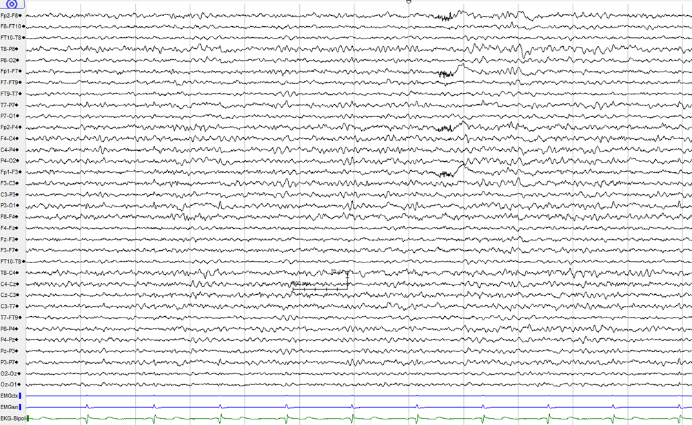 7 Yamada Meng 2010a: 15 23.) EEG-signaali muodostuu eri taajuudella värähtelevistä komponenteista (kuvio 3) (Vanhatalo Soinila 2015). Kuvio 3.