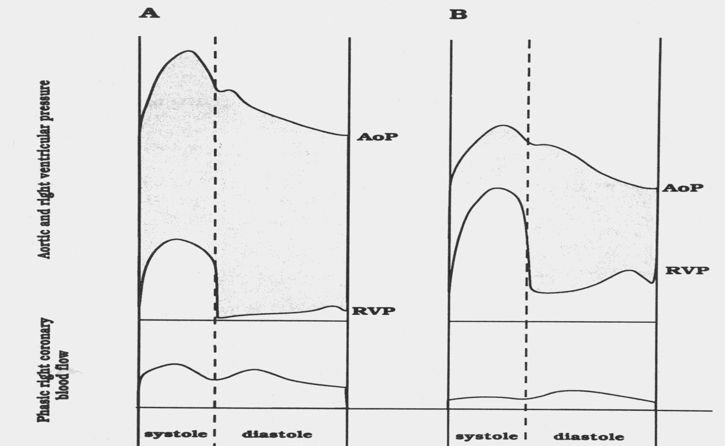 Pulmonaalihypertensio