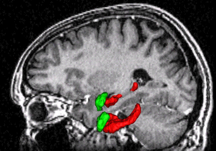 Tuntevat aivot hippokampuksesta (säilömuisti)