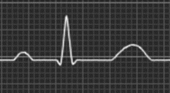 MITEN PIIRTYVÄ EKG KUVAA SYDÄMEN TOIMINTAA avr avl Cabrera kytkentäjärjestyksessä, katsellaan sydäntä loogisessa järjestyksessä kello