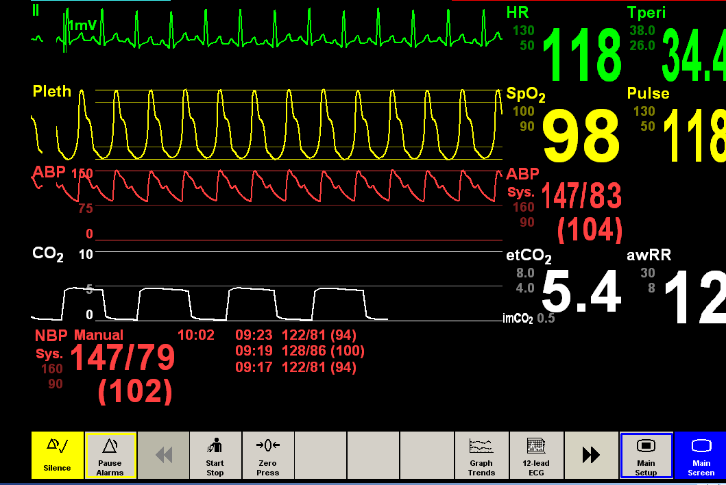 Sinus takykardia