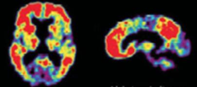 Amyloidin PET-kuvaus PIB-merkkiaine sitoutuu amyloidiin Amyloidiplakkeja alkaa syntyä
