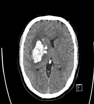 INR 2-3 optimaalisin Fuster ym.