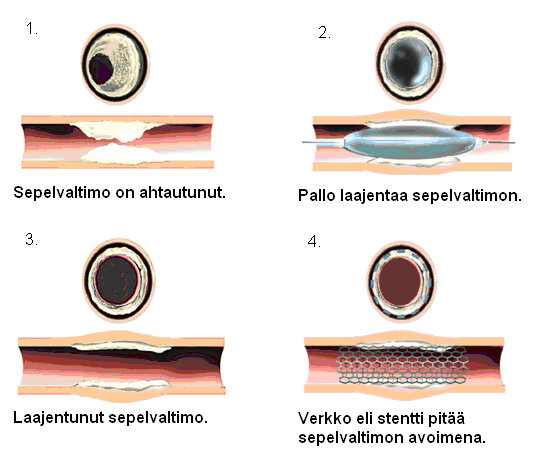 Sepelvaltimon pallolaajennus kuvina: Sepelvaltimoiden ohitusleikkaus Jos pallolaajennuksella ei pystytä palauttamaan sydänlihaksen verenkiertoa, sinulle voidaan tehdä ohitusleikkaus.