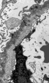 Autosomaaliset geenit X-linked geenit Acute Kidney Failure Normaali glomerulustyvikalvo Prerenal Intrinsic Renal