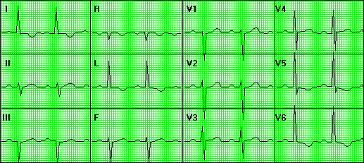 35 Kuva 18. Oikean kammion hypertrofia Vasemman kammion hypertrofiassa (LVH) EKG:ssä näkyy korkeat R-aallot lateraalisissa rintakytkennöissä ja raajakytkennöissä (Kuva 19.). Pidentynyt QRS-kompleksi viittaa LVH:aan ja tällöin QRS>100ms.