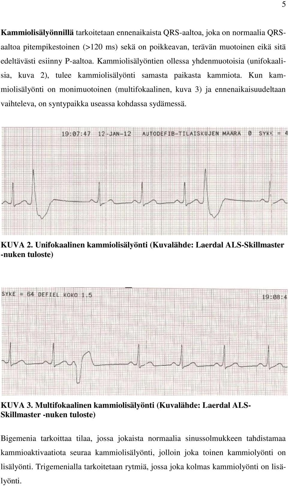 Kun kammiolisälyönti on monimuotoinen (multifokaalinen, kuva 3) ja ennenaikaisuudeltaan vaihteleva, on syntypaikka useassa kohdassa sydämessä. KUVA 2.