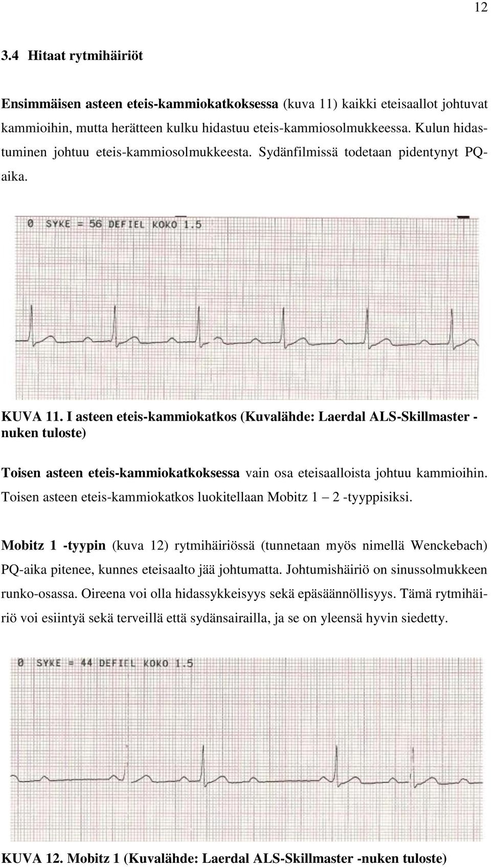 I asteen eteis-kammiokatkos (Kuvalähde: Laerdal ALS-Skillmaster - nuken tuloste) Toisen asteen eteis-kammiokatkoksessa vain osa eteisaalloista johtuu kammioihin.