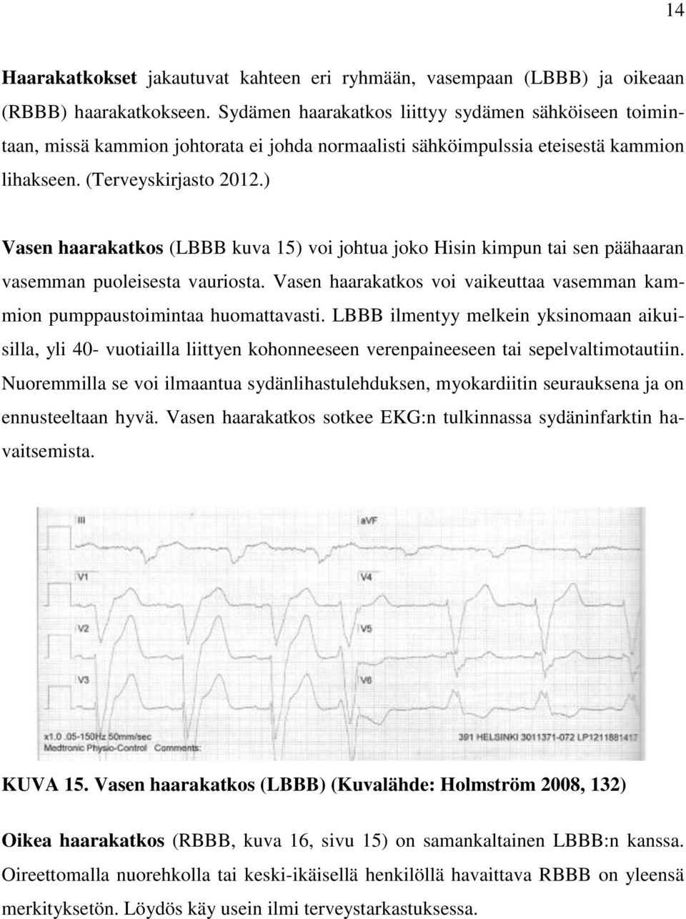 ) Vasen haarakatkos (LBBB kuva 15) voi johtua joko Hisin kimpun tai sen päähaaran vasemman puoleisesta vauriosta. Vasen haarakatkos voi vaikeuttaa vasemman kammion pumppaustoimintaa huomattavasti.