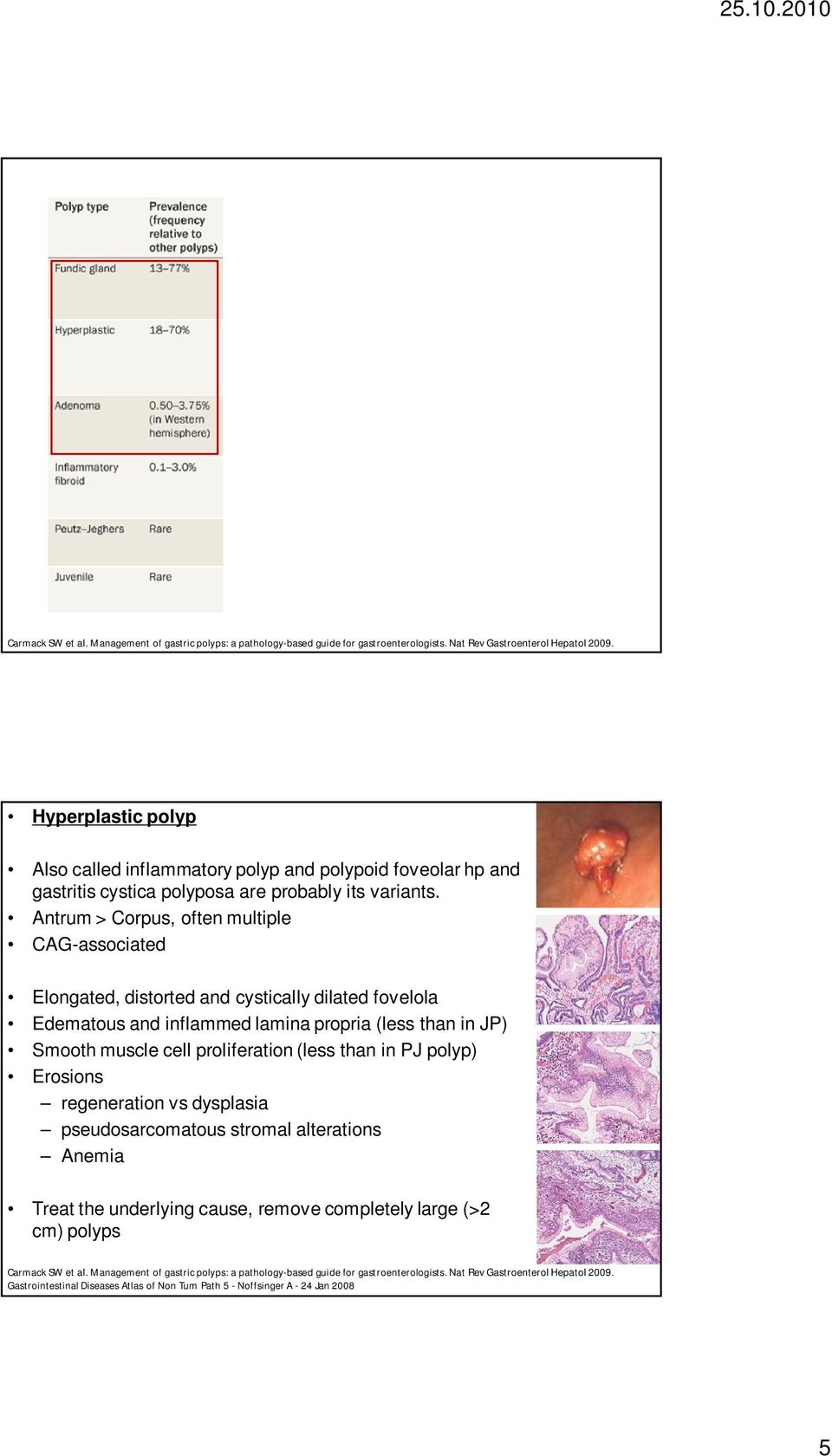 Antrum > Corpus, often multiple CAG-associated Elongated, distorted and cystically dilated fovelola Edematous and inflammed lamina propria (less than in JP) Smooth muscle cell proliferation (less