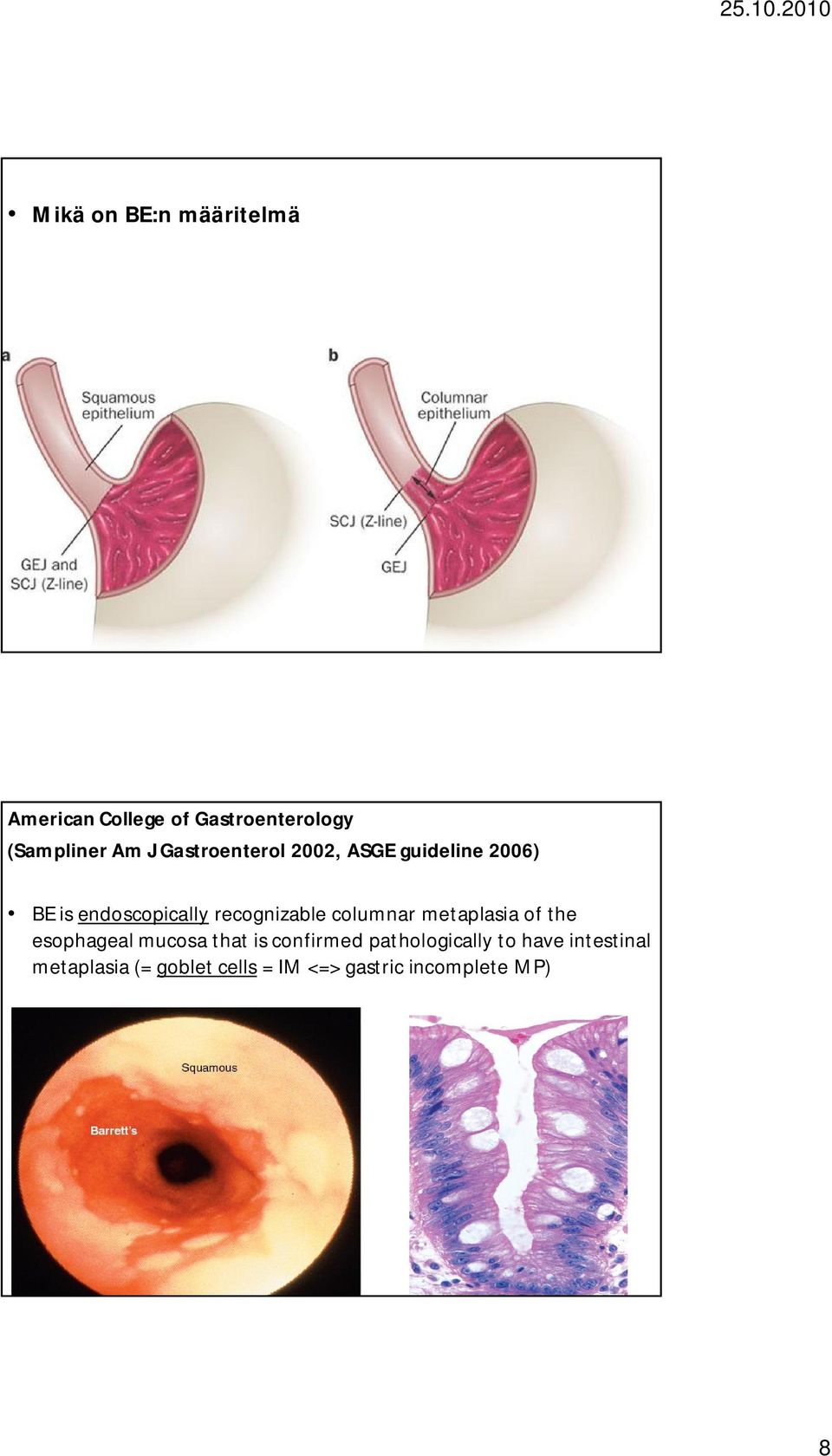 (Sampliner Am J Gastroenterol 2002, ASGE guideline 2006) BE is endoscopically recognizable columnar metaplasia of the