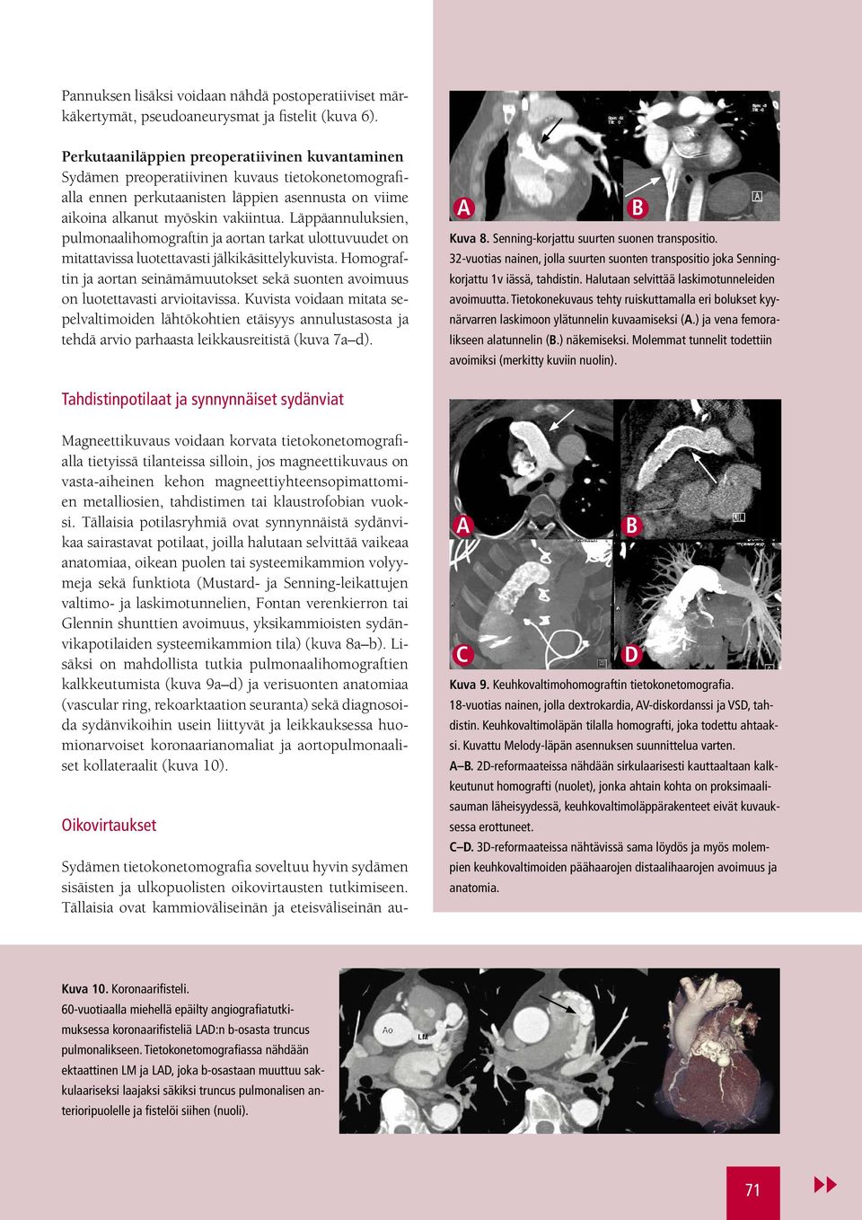 Läppäannuluksien, pulmonaalihomograftin ja aortan tarkat ulottuvuudet on mitattavissa luotettavasti jälkikäsittelykuvista.