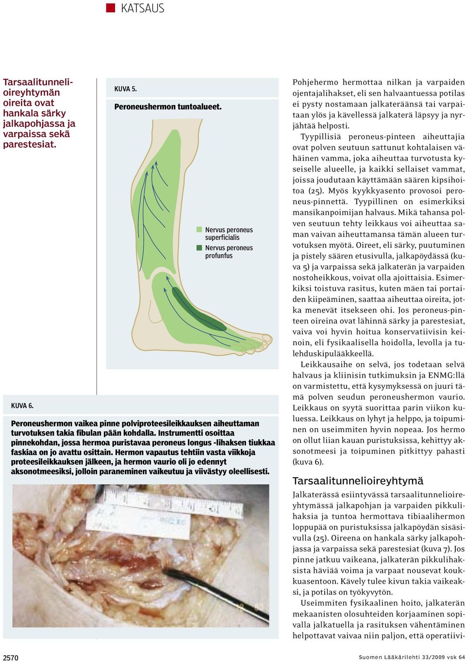 Instrumentti osoittaa pinnekohdan, jossa hermoa puristavaa peroneus longus -lihaksen tiukkaa faskiaa on jo avattu osittain.