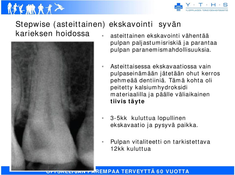 Asteittaisessa ekskavaatiossa vain pulpaseinämään jätetään ohut kerros pehmeää dentiiniä.