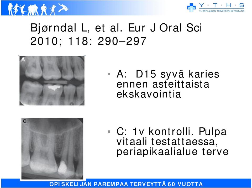 syvä karies ennen asteittaista