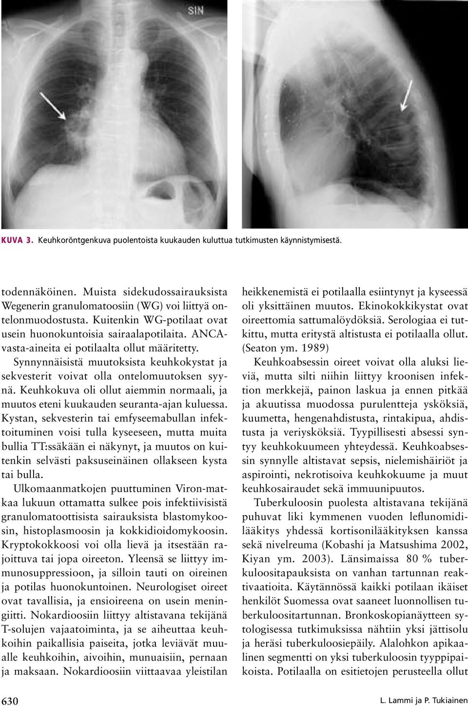 Synnynnäisistä muutoksista keuhkokystat ja sekvesterit voivat olla ontelomuutoksen syynä. Keuhkokuva oli ollut aiemmin normaali, ja muutos eteni kuukauden seuranta-ajan kuluessa.