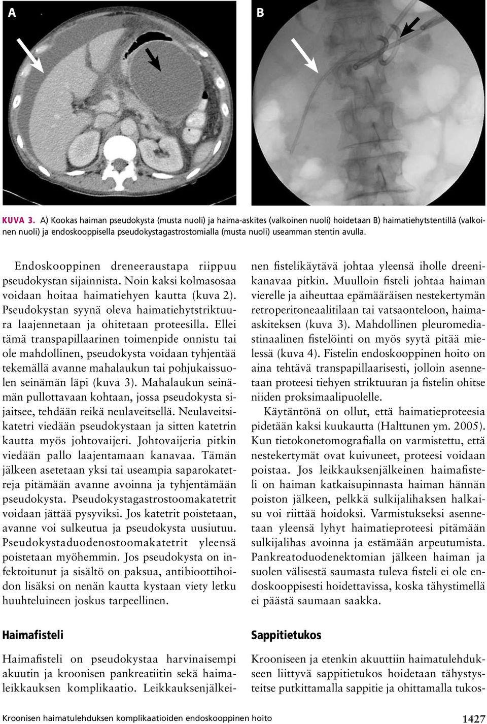 stentin avulla. Endoskooppinen dreneeraustapa riippuu pseudokystan sijainnista. Noin kaksi kolmasosaa voidaan hoitaa haimatiehyen kautta (kuva 2).