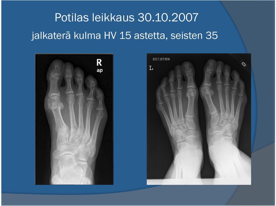 2007 jalkaterä