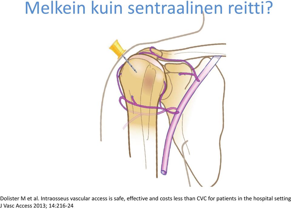 Intraosseus vascular access is safe, effective