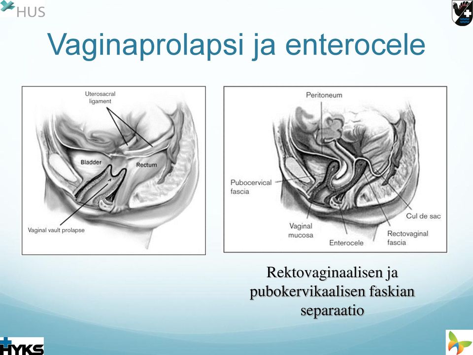 Rektovaginaalisen ja