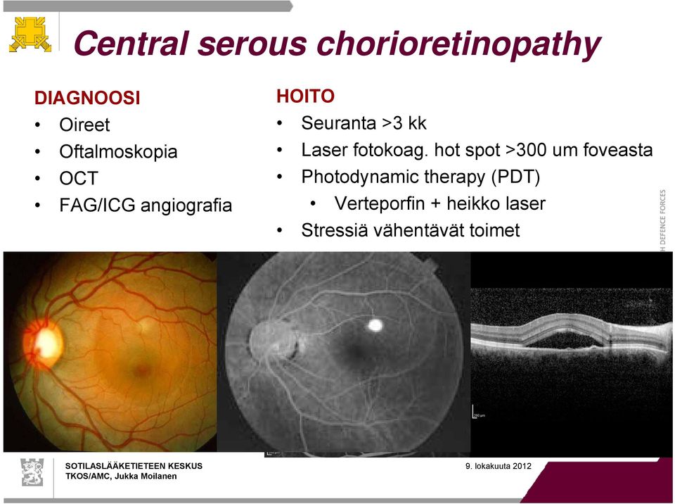 hot spot >300 um foveasta OCT Photodynamic therapy (PDT)