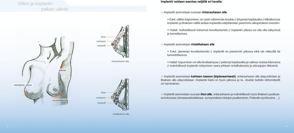 lihas rauhanen implantti Haitat: mahdollisesti kohonnut kovettumisriski // implantin yläosa voi olla olla näkyvissä ja tunnettavissa. > Implantti asennetaan rintalihaksen alle.