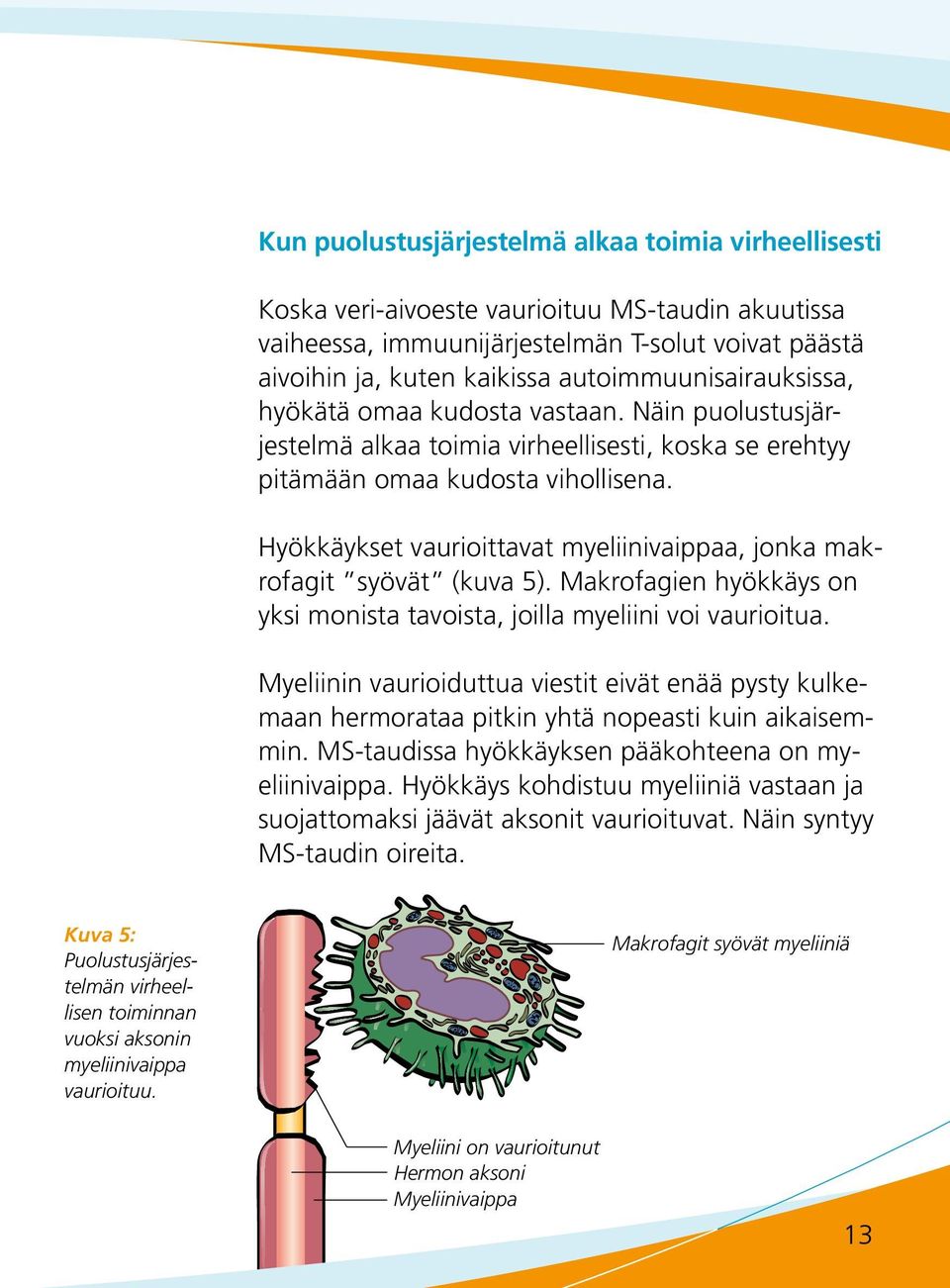 Hyökkäykset vaurioittavat myeliinivaippaa, jonka makrofagit syövät (kuva 5). Makrofagien hyökkäys on yksi monista tavoista, joilla myeliini voi vaurioitua.