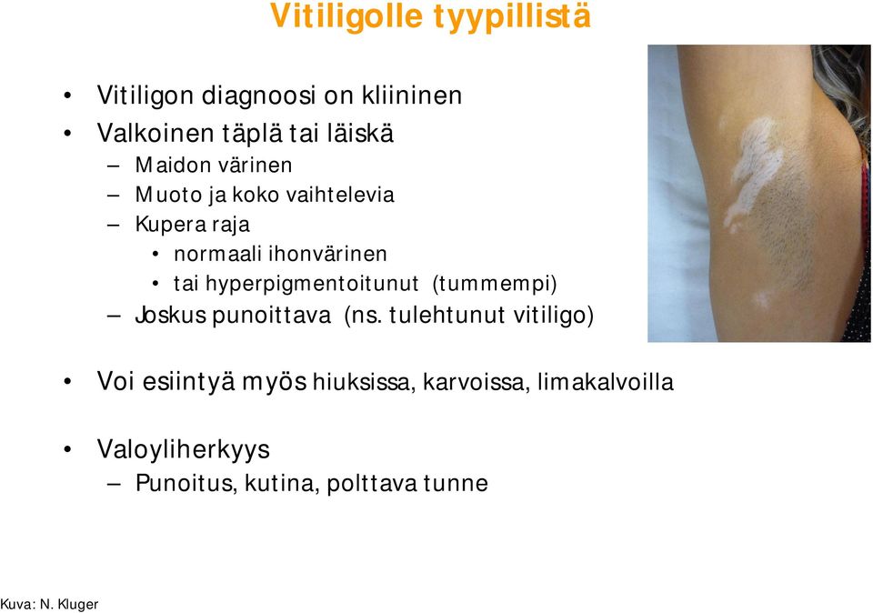 hyperpigmentoitunut (tummempi) Joskus punoittava (ns.