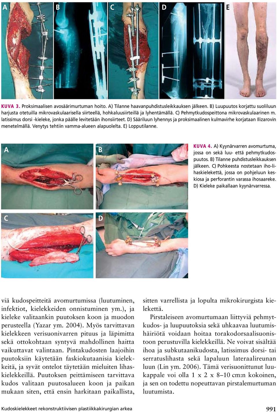 latissimus dorsi kieleke, jonka päälle levitetään ihonsiirteet. D) Sääriluun lyhennys ja proksimaalinen kulmavirhe korjataan Ilizarovin menetelmällä. Venytys tehtiin vamma-alueen alapuolelta.