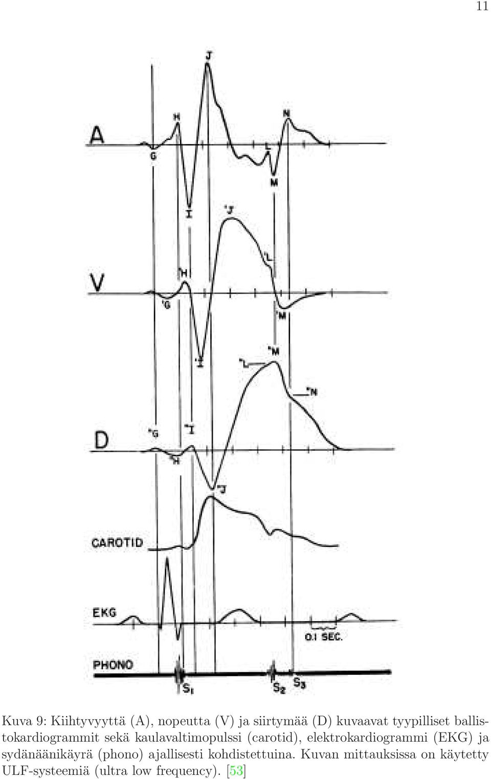 elektrokardiogrammi (EKG) ja sydänäänikäyrä (phono) ajallisesti