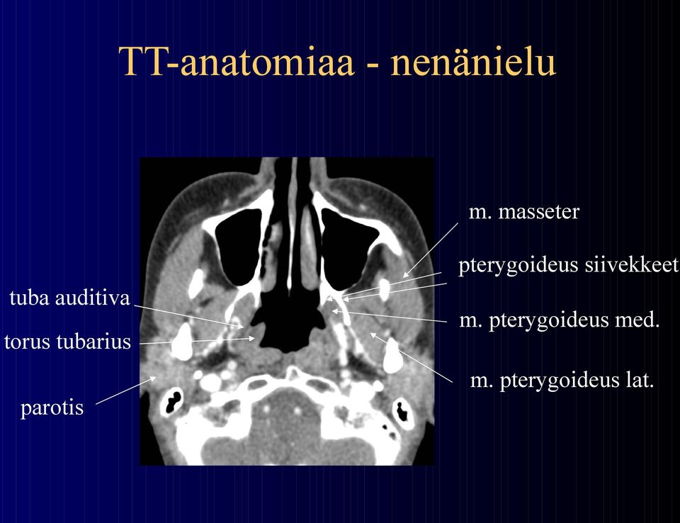 tuba auditiva torus tubarius m.