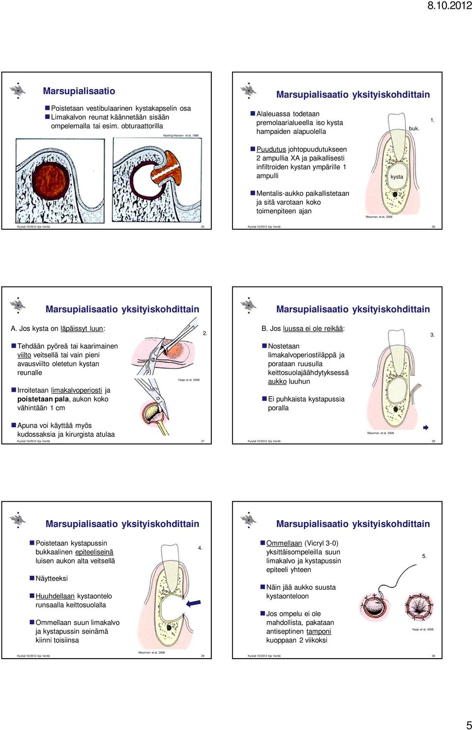 Puudutus johtopuudutukseen 2 ampullia XA ja paikallisesti infiltroiden kystan ympärille 1 ampulli Mentalis-aukko paikallistetaan ja sitä varotaan koko toimenpiteen ajan Meurman et al.