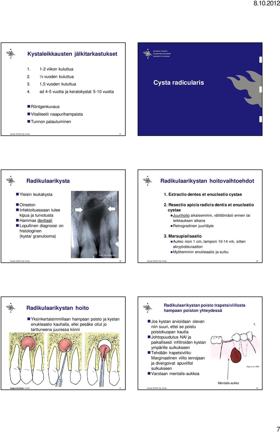 Oireeton Infektoituessaan tulee kipua ja turvotusta Hammas devitaali Lopullinen diagnoosi on histologinen (kysta/ granulooma) 1. Extractio dentes et enucleatio cystae 2.