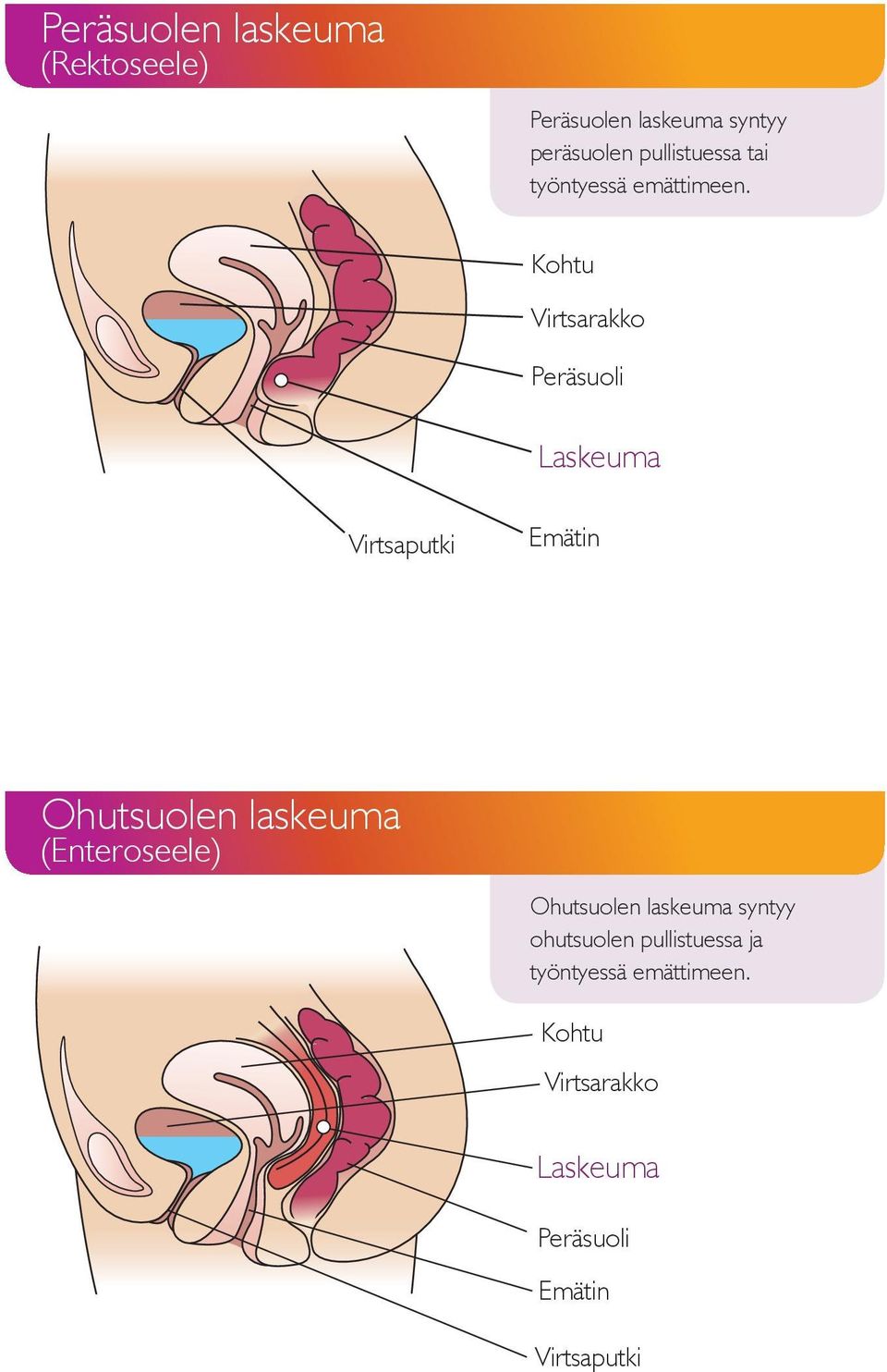 Kohtu Virtsarakko Peräsuoli Laskeuma Rectal prolapse Virtsaputki Emätin Uterine Prolapse