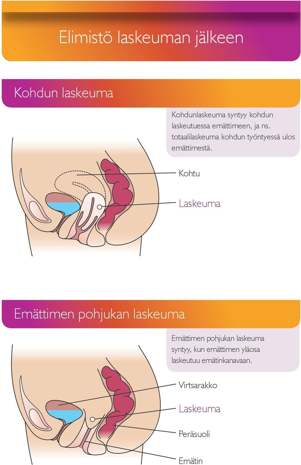 Kohtu Laskeuma Uterine Prolapse Small bowel prolapse Emättimen pohjukan laskeuma Emättimen