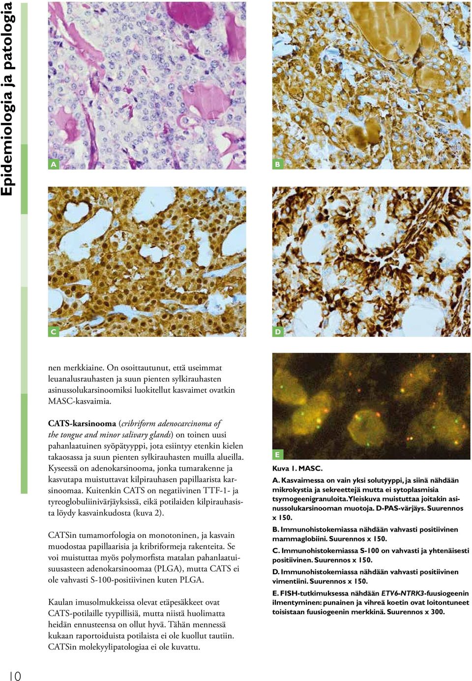 CATS-karsinooma (cribriform adenocarcinoma of the tongue and minor salivary glands) on toinen uusi pahanlaatuinen syöpätyyppi, jota esiintyy etenkin kielen takaosassa ja suun pienten sylkirauhasten