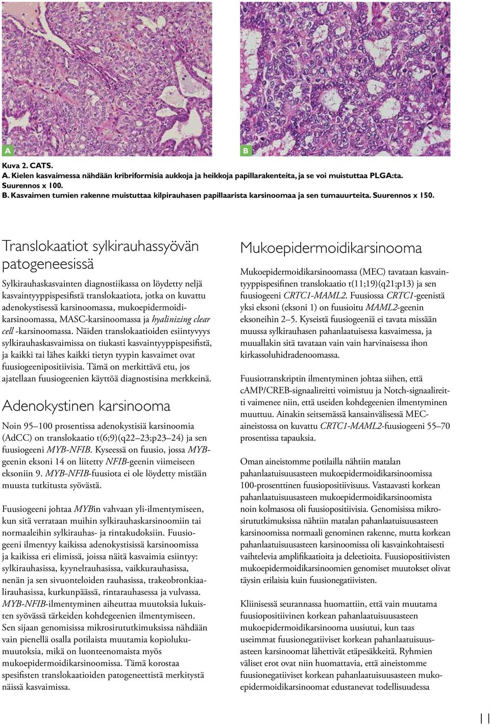 B Translokaatiot sylkirauhassyövän patogeneesissä Sylkirauhaskasvainten diagnostiikassa on löydetty neljä kasvaintyyppispesifistä translokaatiota, jotka on kuvattu adenokystisessä karsinoomassa,